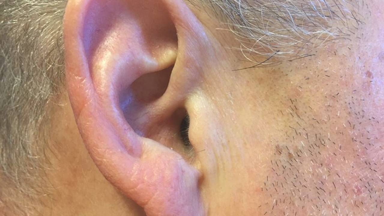 Veel mensen hebben last van bromtonen.