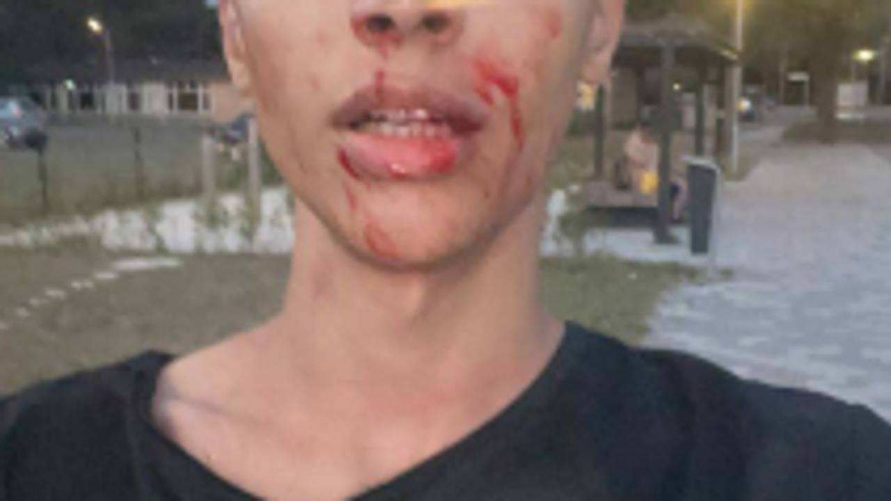 De man werd in zijn gezicht, op zijn hoofd en in zijn nek geslagen (eigen foto).