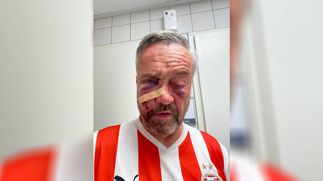 Anthony van der Vloet, kort nadat hij was toegetakeld (eigen foto).