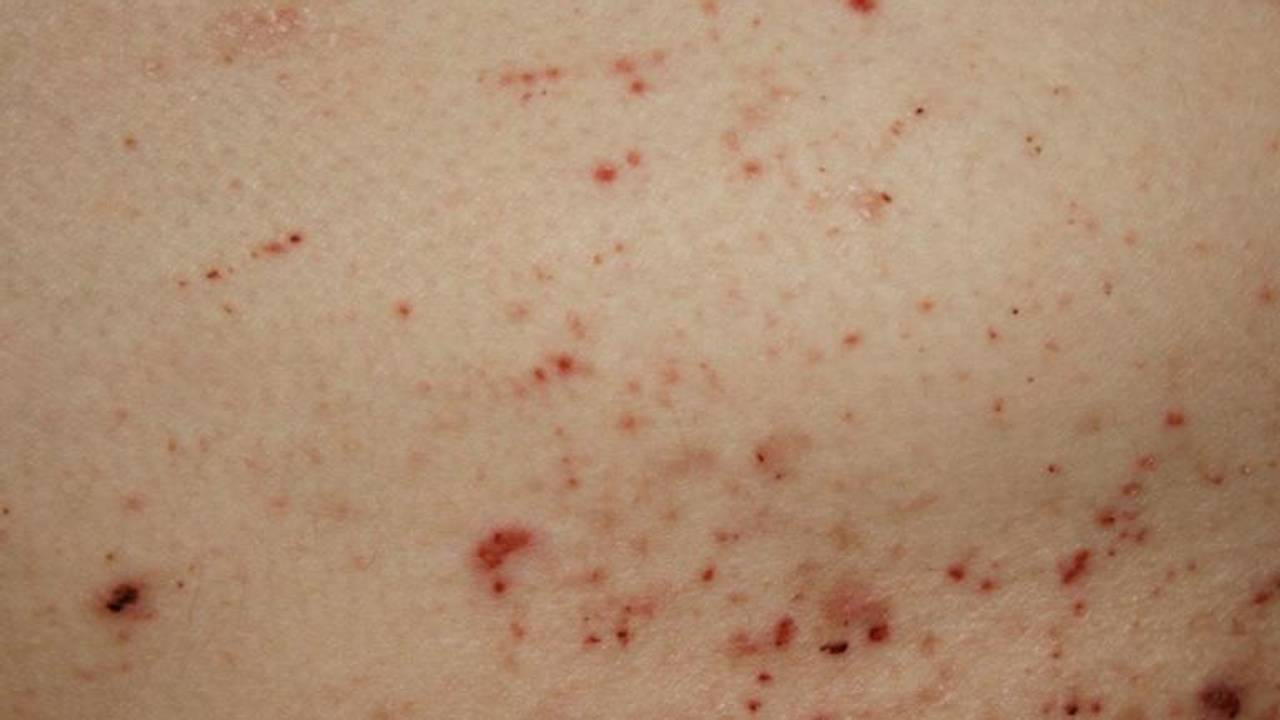 Zo ziet schurft er uit (foto: RIVM)