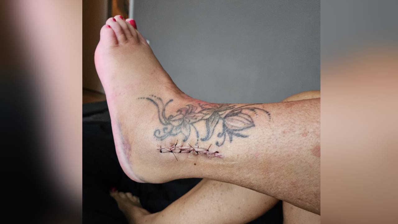 De enkel van Sabine is op twee plekken gebroken en voorzien van een ijzeren pin (foto: Sabine).