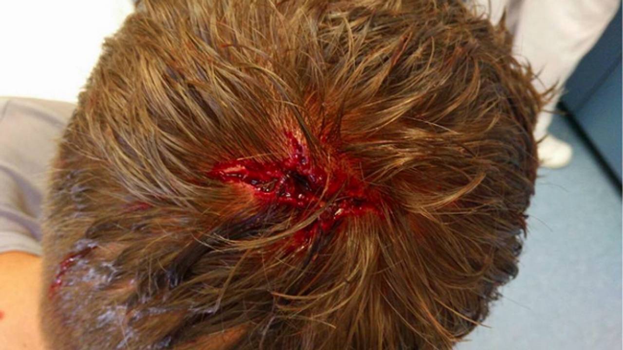 Wond bij Tom Winkel (bron Tom Winkel / Facebook)