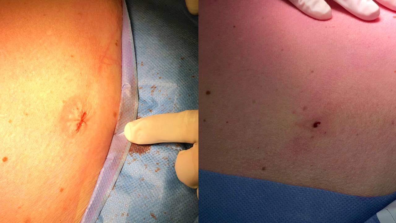 Links het litteken na een gewone kijkoperatie, rechts na de Percuvance-techniek (foto's: Màxima Medi