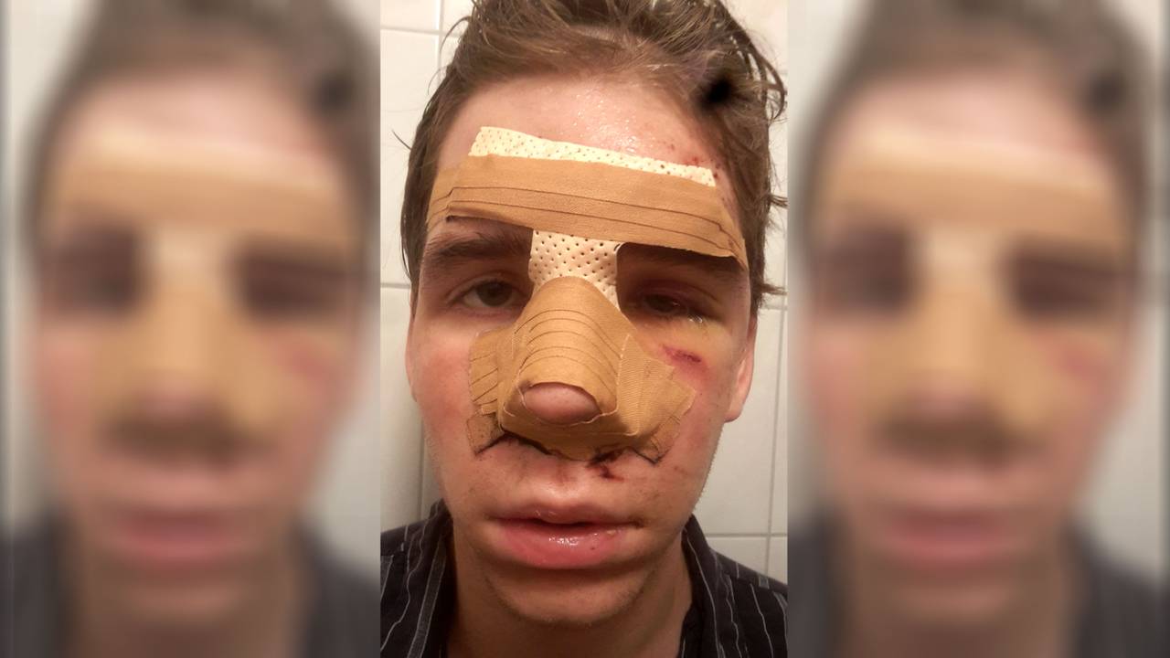 Stefan (21) na de mishandeling.