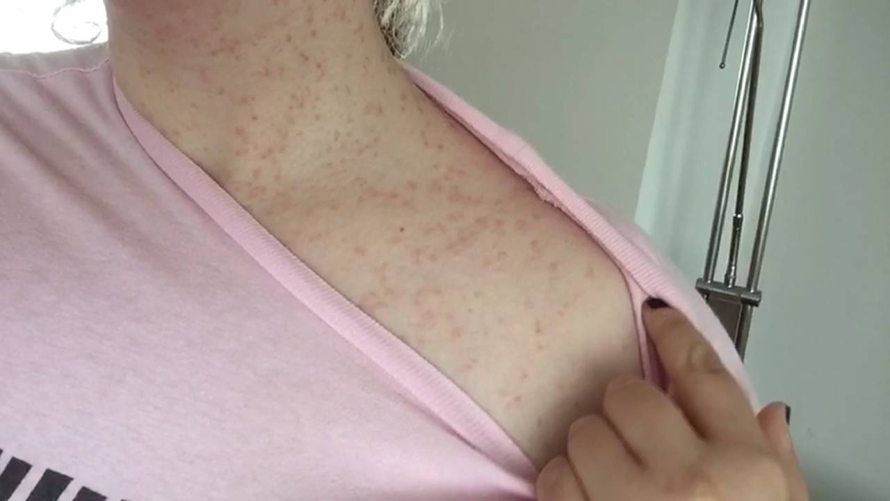 De processierups heeft afgelopen weekend voor flink wat problemen gezorgd. (Foto: Omroep Brabant)