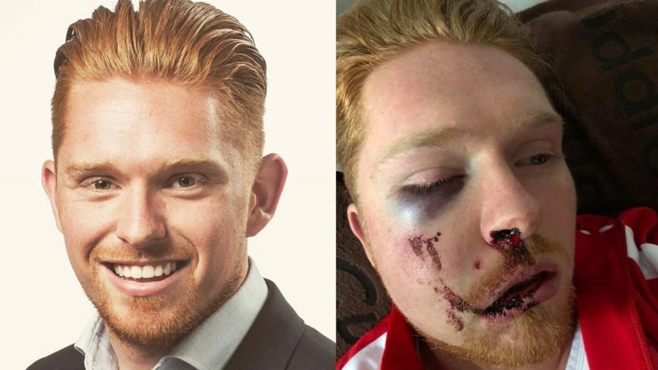 Van de buitenkant zie je het niet maar in het gezicht van Jean Paul zijn twee metalen platen geplaatst (foto's: Jean Paul).