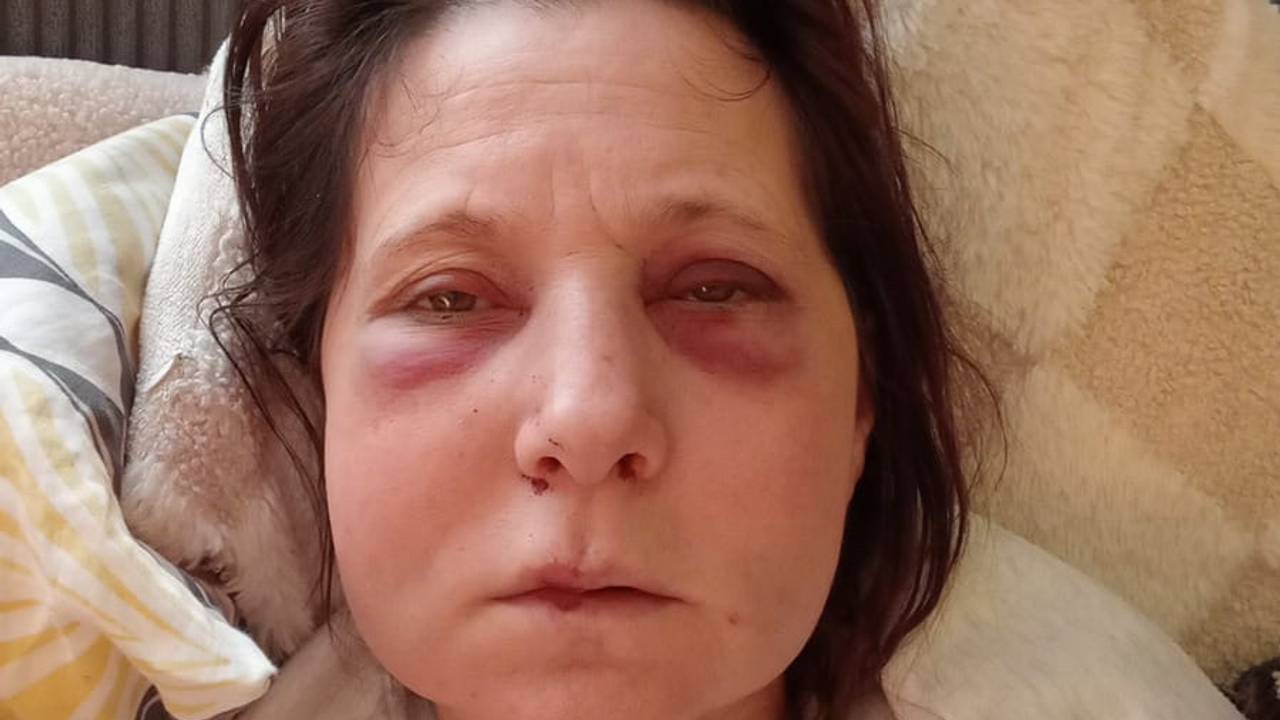 Dorota haar verwondingen na het ongeluk