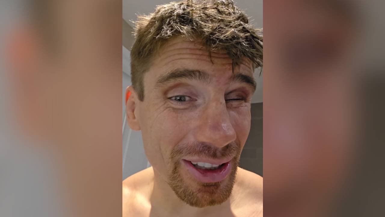 Rico Verhoeven is bont en blauw geslagen in voorbereiding op zijn boksdebuut (foto: Instagram Rico Verhoeven).