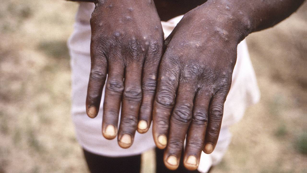 Monkeypox virus diagnosed at a disability center