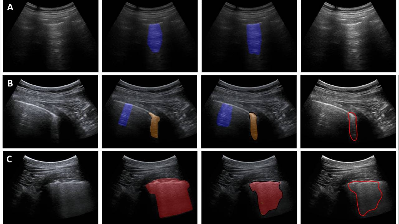 Longfoto's met en zonder de zelflerend analyse (foto: TU Eindhoven)