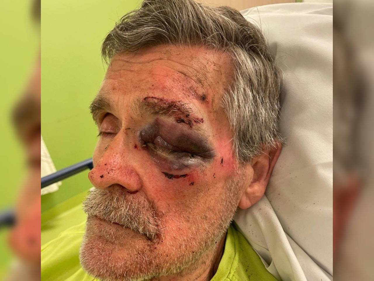 Wim in het ziekenhuis na de mishandeling (foto: Werner Brul).