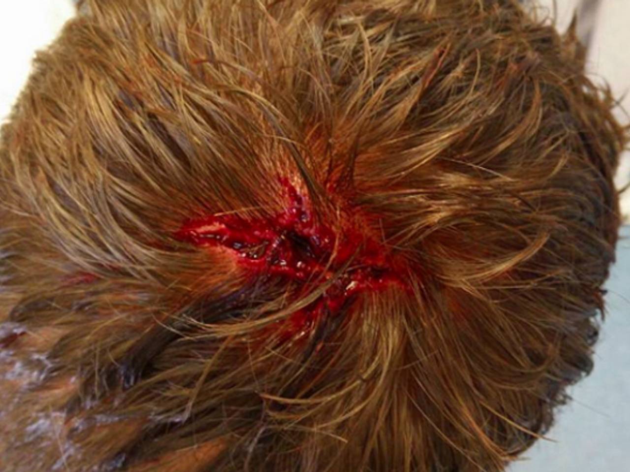 Wond bij Tom Winkel (bron Tom Winkel / Facebook)