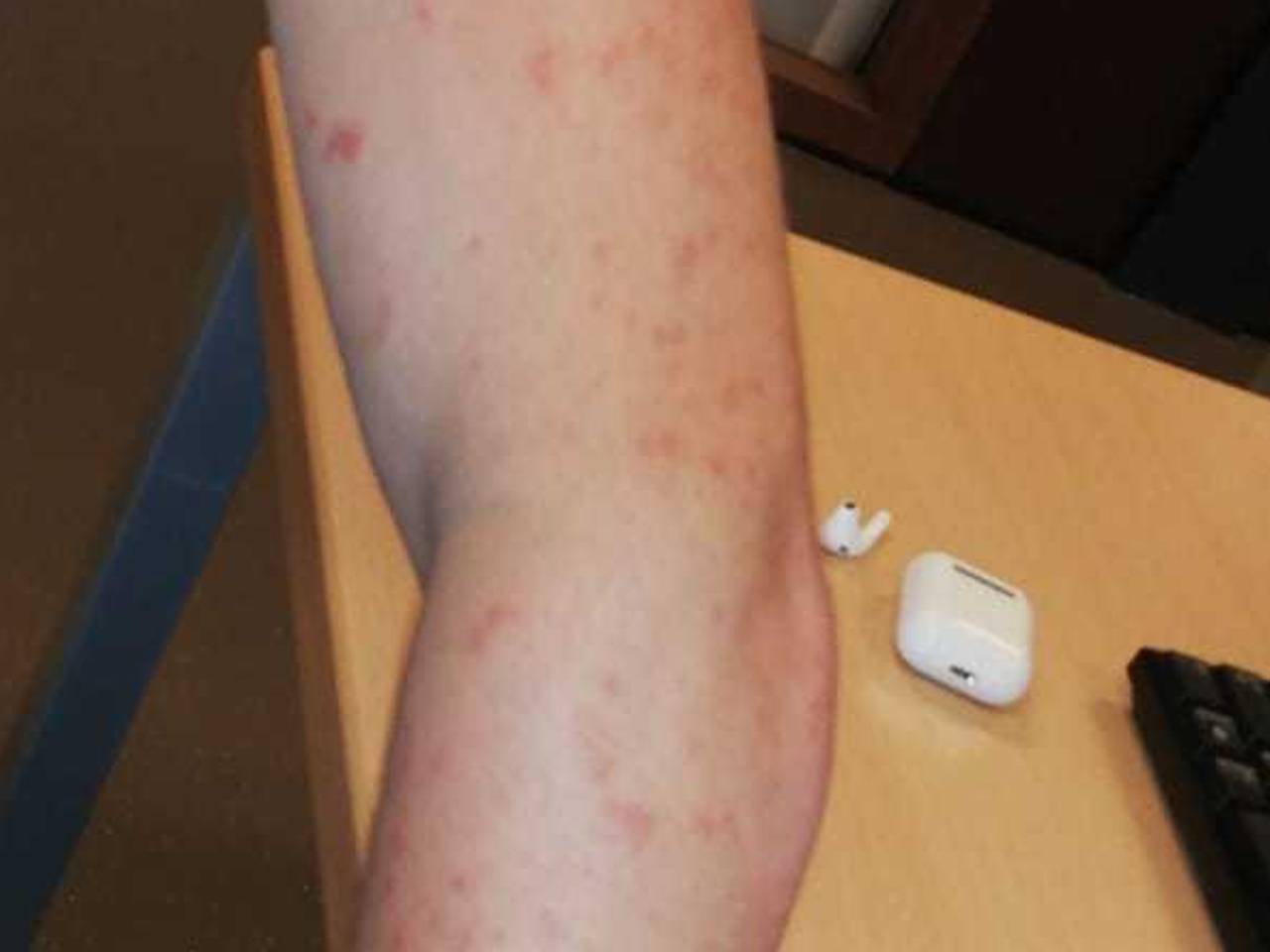 Jort heeft veel last van de bultjes die hij kreeg door de eikenprocessierups (Foto: Ingrid Coppelmans).