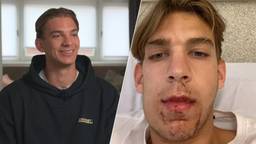 Tijn Jansen liep vorig jaar een dubbele kaakbreuk op door een mishandeling