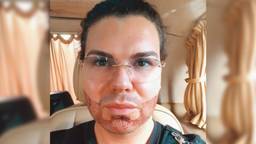 Roy Donders na de ingreep (foto: instagram Roy Donders).
