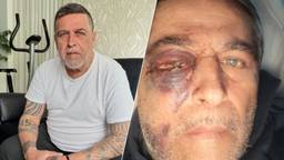 Ercan is door de mishandeling voor de rest van zijn leven blind aan zijn linkeroog (foto's: Omroep Brabant / privéfoto - deze is gespiegeld).