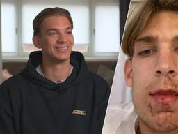 Tijn Jansen liep vorig jaar een dubbele kaakbreuk op door een mishandeling