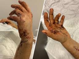 De hand van het slachtoffer zat vol steekwonden (privéfoto).
