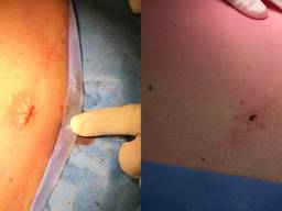 Links het litteken na een gewone kijkoperatie, rechts na de Percuvance-techniek (foto's: Màxima Medisch Centrum)