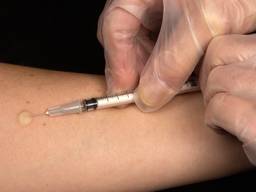 Met een Mantoux-test kan tuberculose worden vastgesteld. (Foto: Wikipedia)