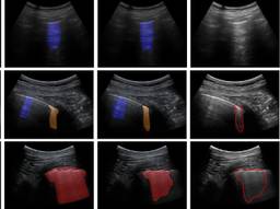 Longfoto's met en zonder de 'deep learning' analyse (foto: TU Eindhoven)