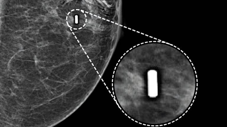 Het magneetje wordt in de borst geplaatst. (foto: Sirius Medical)