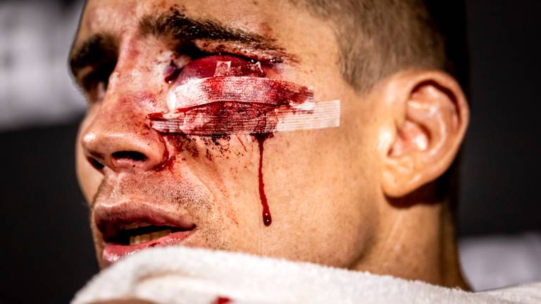 Kickbokser Rico Verhoeven zwaar gehavend na zijn gevecht tegen Jamal Ben Saddik (foto: ANP 2021/Remko de Waal).