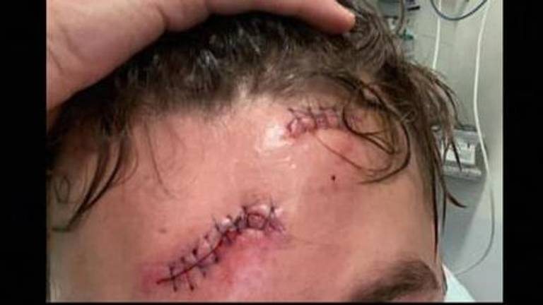 Twee steekwonden in zijn voorhoofd hield het slachtoffer over aan de steekpartij (privéfoto)