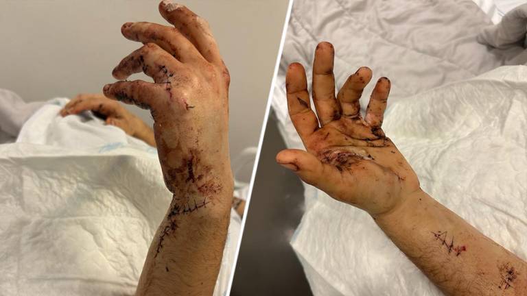 De hand van het slachtoffer zat vol steekwonden (privéfoto).