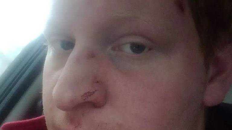 Michel (21) werd zwaar mishandeld op 11-11: 'Het duurde zeker 5 minuten' 