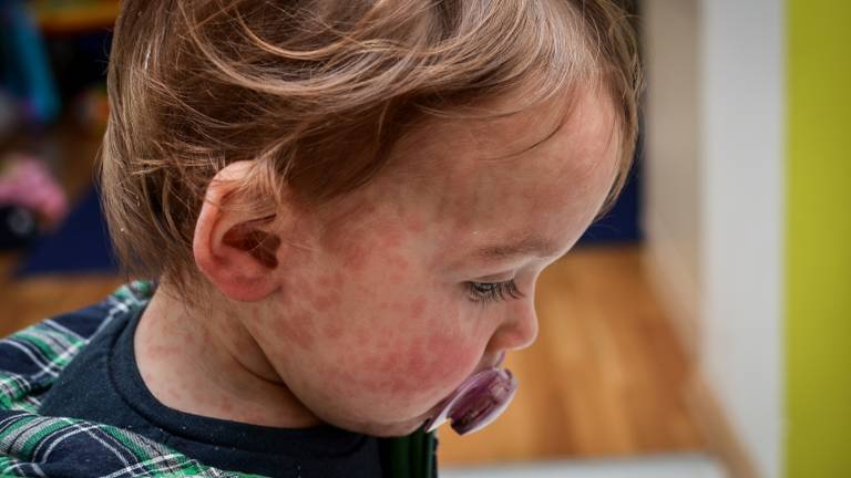 GGD gaat kinderen vanaf zes maanden vaccineren tegen de mazelen