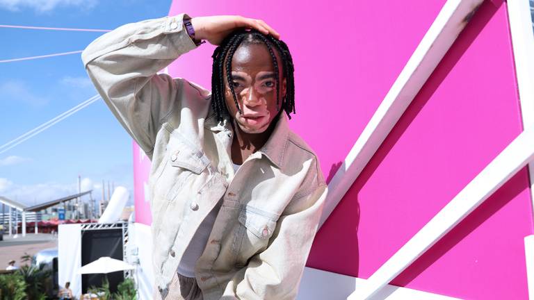 Jarenlang smeerde Terence crème om zijn vlekken te verbergen. (Foto: Terence Munzemba)