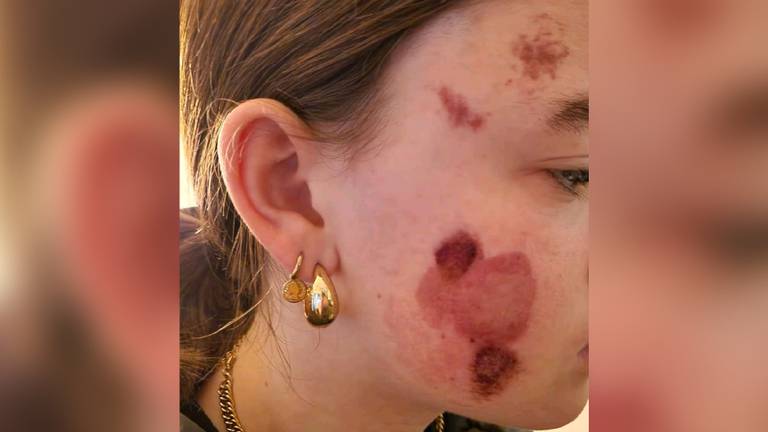 Het meisje liep schaafwonden op en raakte gewond aan haar oog (foto: politie).