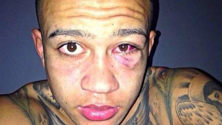 Blessure van Depay (Foto: Twitter)