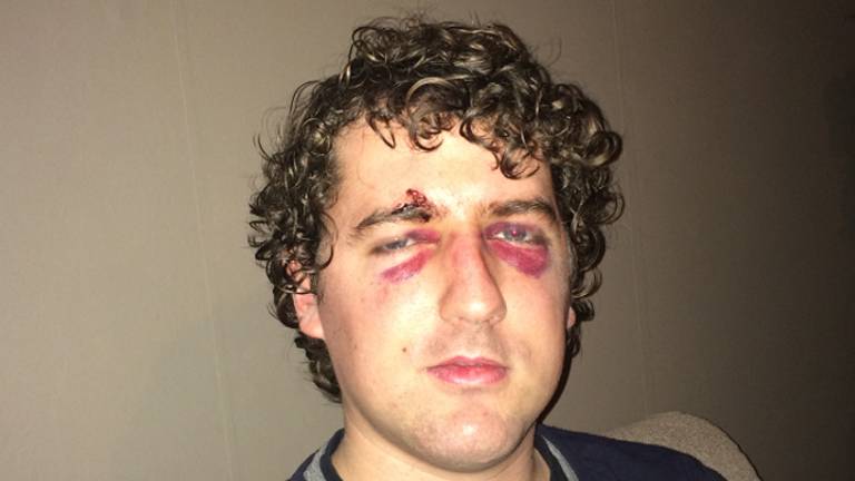 Bram Klemann 30 Ernstig Mishandeld In Boxtel Tijdens Carnaval Ik Werd Wakker In Een Plas Bloed Omroep Brabant