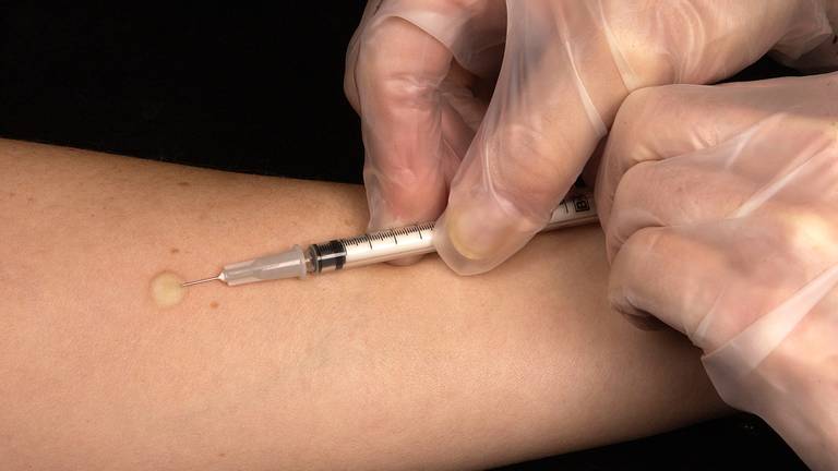 Met een Mantoux-test kan tuberculose worden vastgesteld. (Foto: Wikipedia)