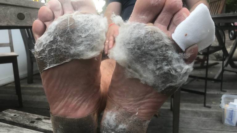 De voeten van Frans van Schalk na het lopen van de Walk to Fight Cancer