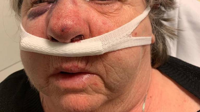 De vrouw had gebroken jukbeenderen en een gebroken neus. Foto: Facebook/Babette Hermans