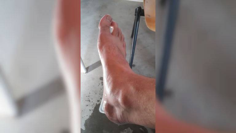 Arie had een hele zwelling op zijn voet nadat hij door wespen was gestoken (Foto: Arie Benschop).