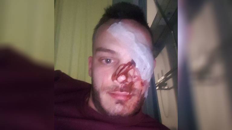 Ties is blind aan één oog na mishandeling: dader moet half jaar de cel in