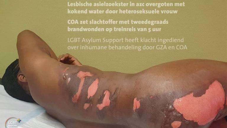 Het slachtoffer liep hevige brandwonden op ((foto: LGBT Asylum Support).