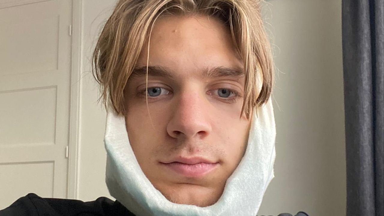 Tijn Jansen liep een dubbele kaakbreuk op door een mishandeling (privéfoto)..