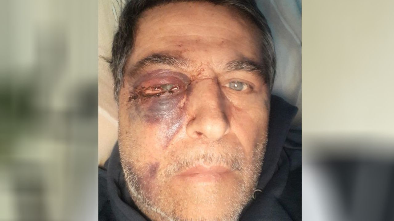 Ercan kort na de mishandeling (privéfoto is gespiegeld).