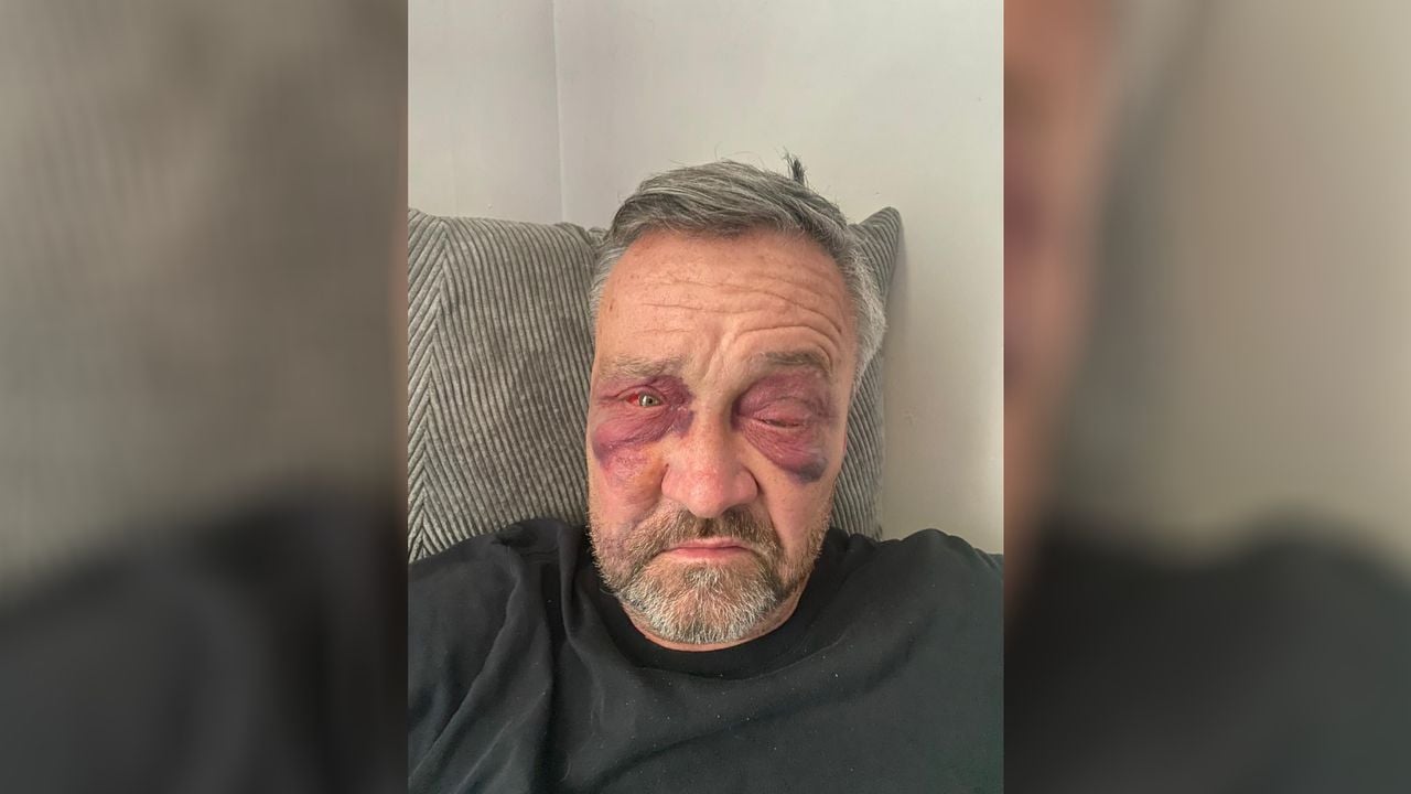 Anthony van der Vloet komt thuis bij van de mishandeling (eigen foto). 