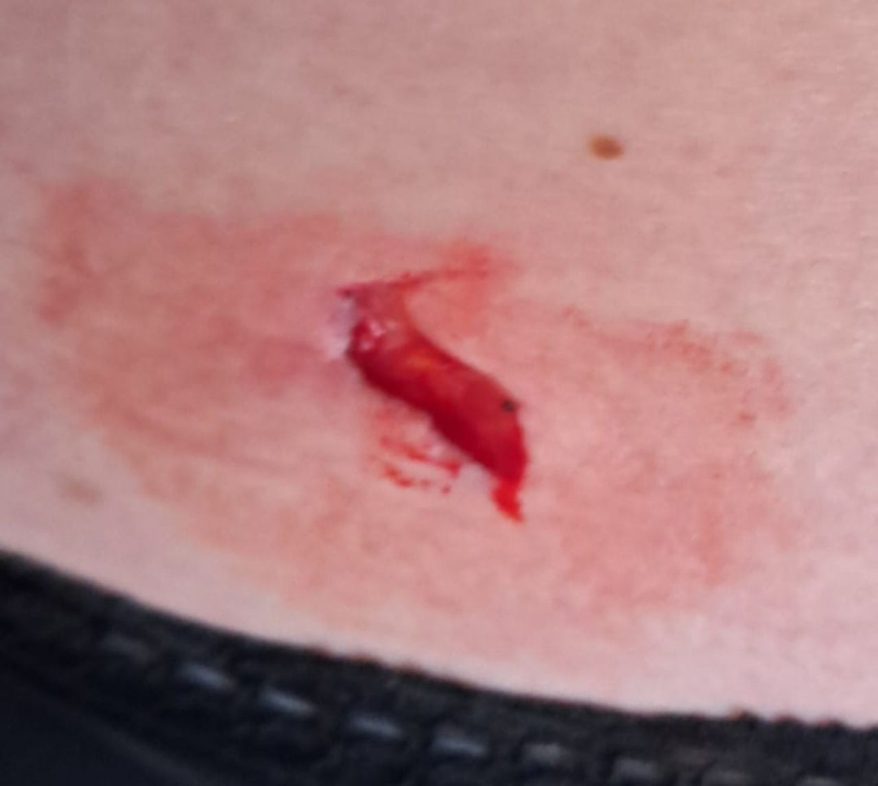 Een close up van de wond van Ankie's onderrug (foto: Ankie)