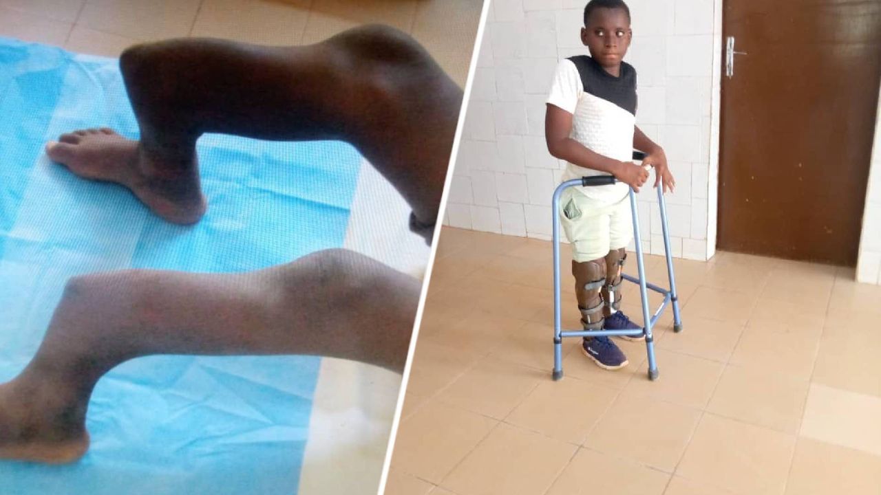 Ernstige vergroeiing bij jongetje in Burkina Faso (foto: via Frank Rahusen).