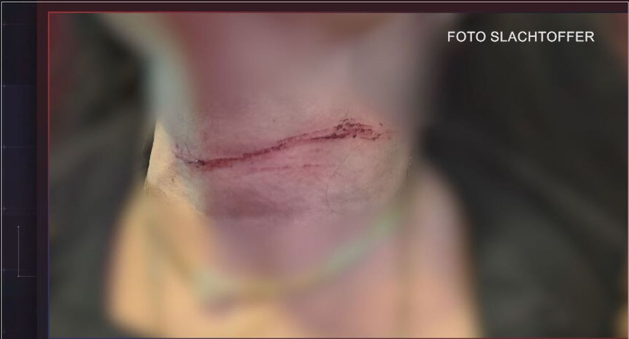 De verwonding die de vrouw overhield aan haar mishandeling (foto: slachtoffer/Bureau Brabant).