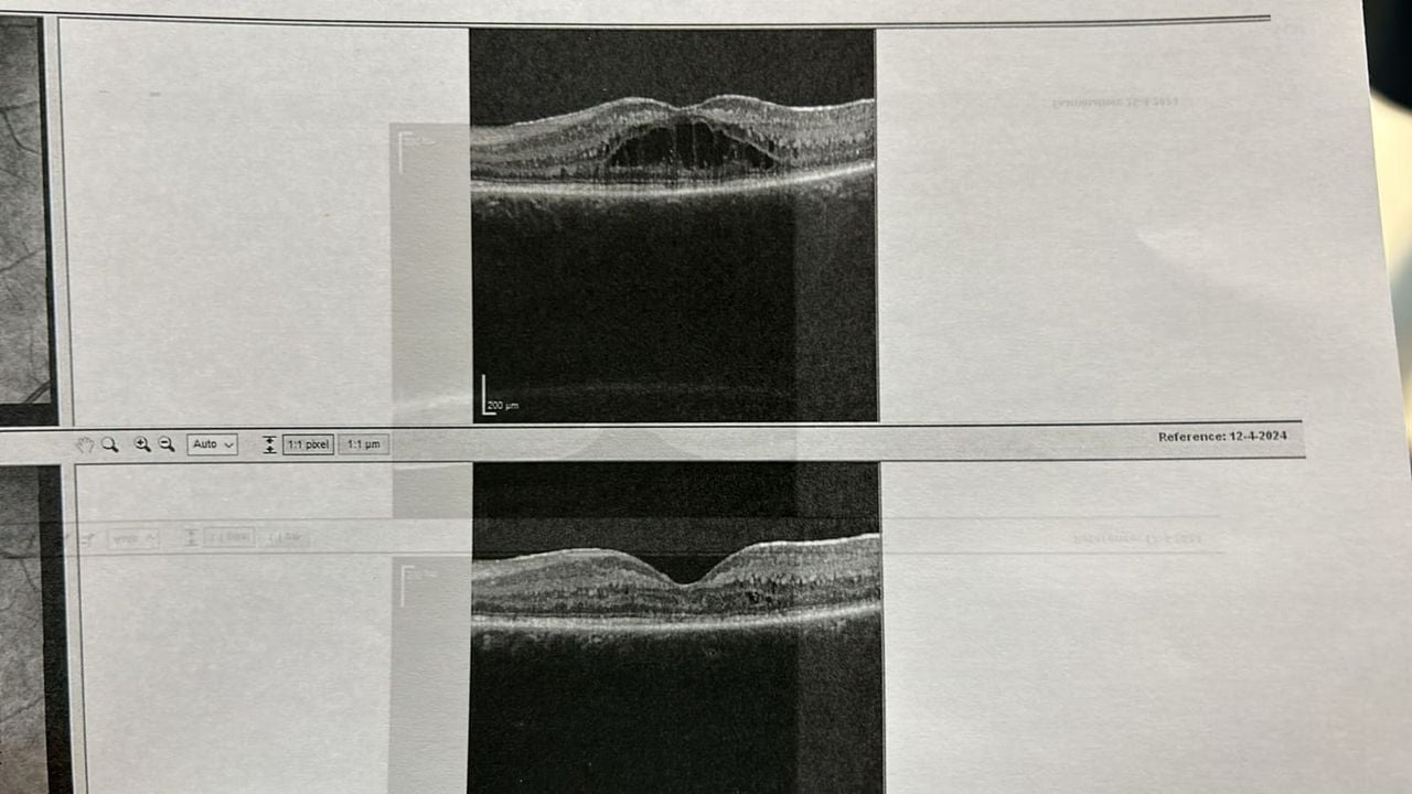 Boven: In een oogbol met DCMD. Onder: Een gezonde oogbol (Foto: Via Wim Bekkers)