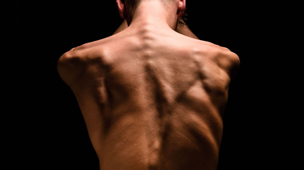 Toen Max groeide werd zijn rug steeds krommer. (Foto: Arjan Spannenburg)