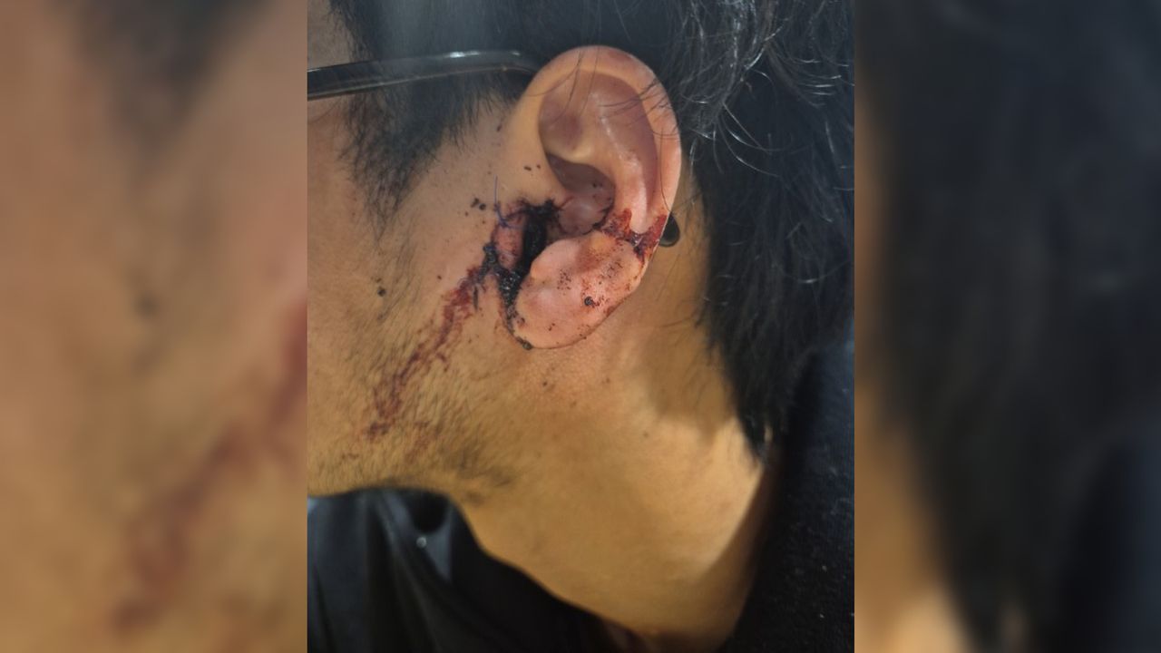 De schade aan het oor van het slachtoffer na de mishandeling (foto: politie).